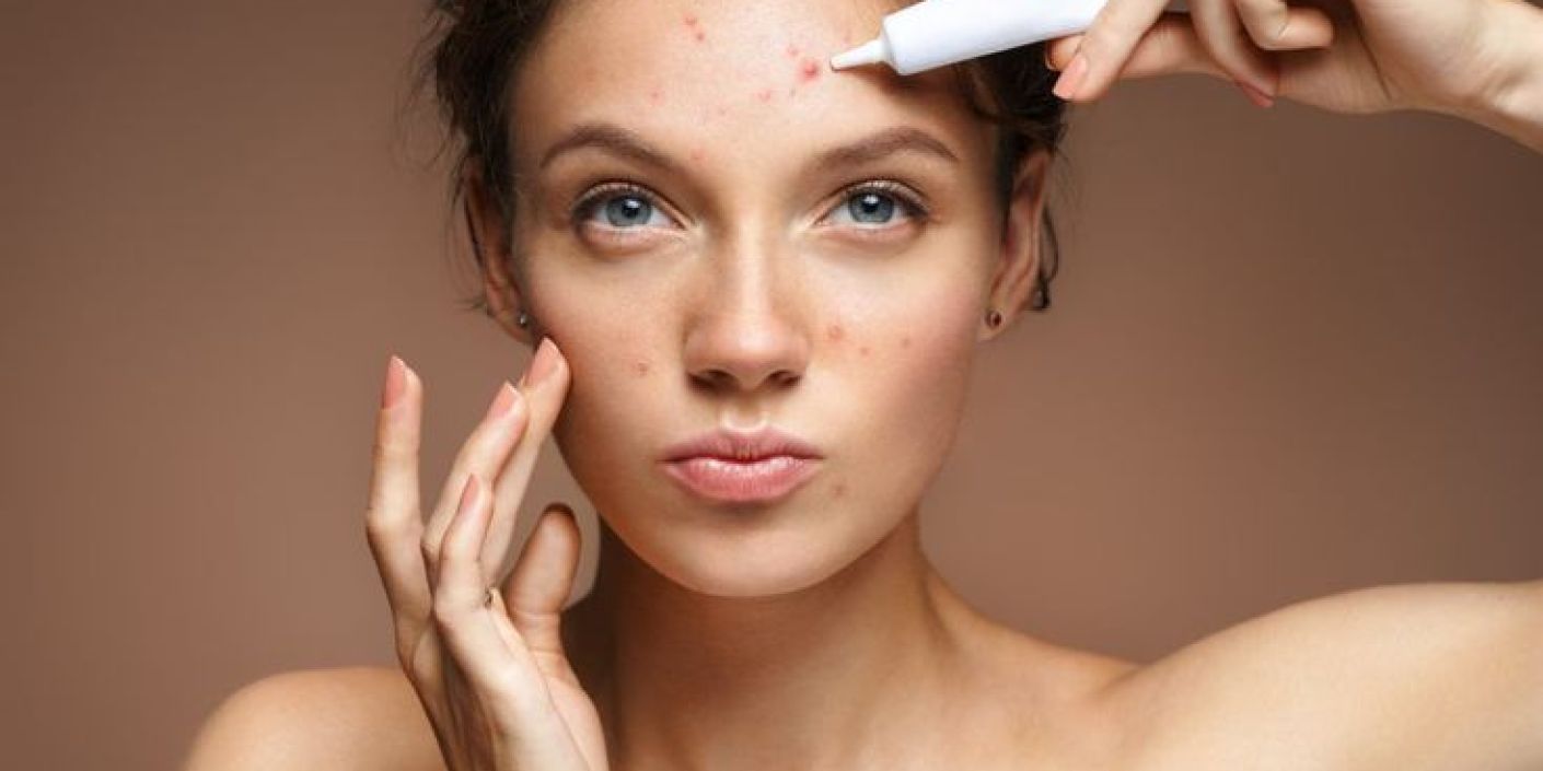 Wanita Berjerawat (Pinterest: affderm.com)