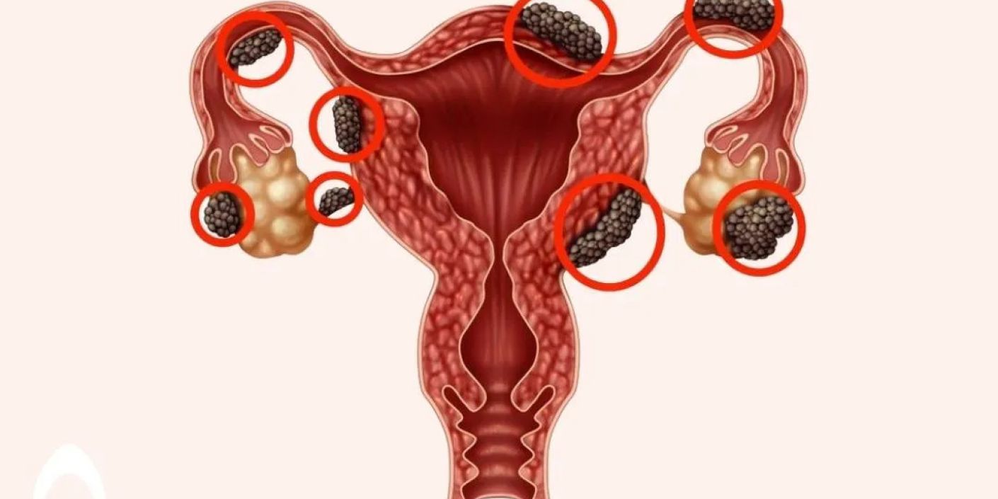 FOTO: endometriosis (sumber: Bocah Indonesia)